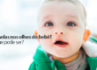 Remelas-nos-olhos-do-bebe-O-que-pode-ser
